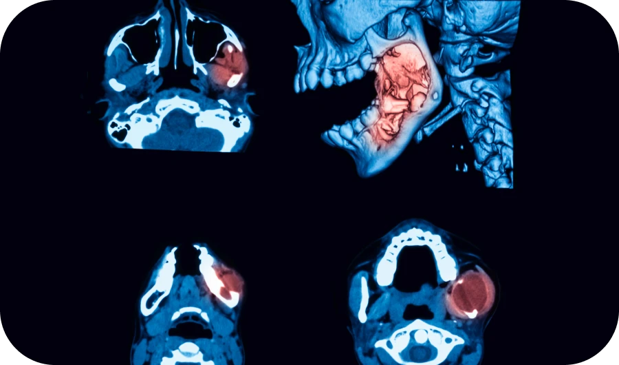 kyste abces dentaire