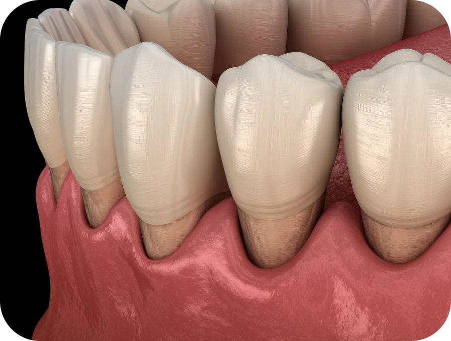 traitement parodontite docteur sierocki