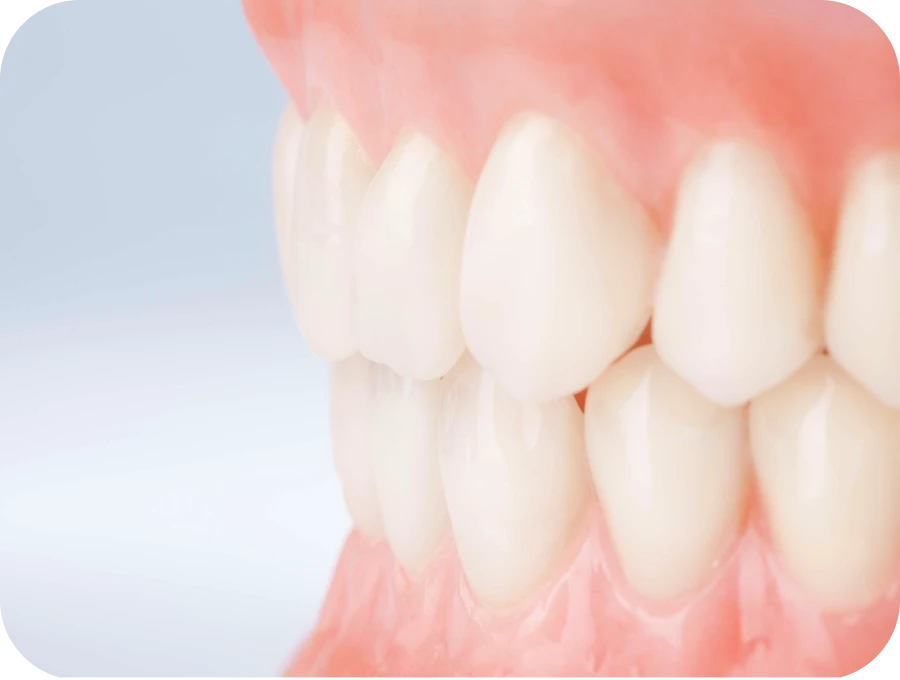 amenagement gingival pre-prothetique