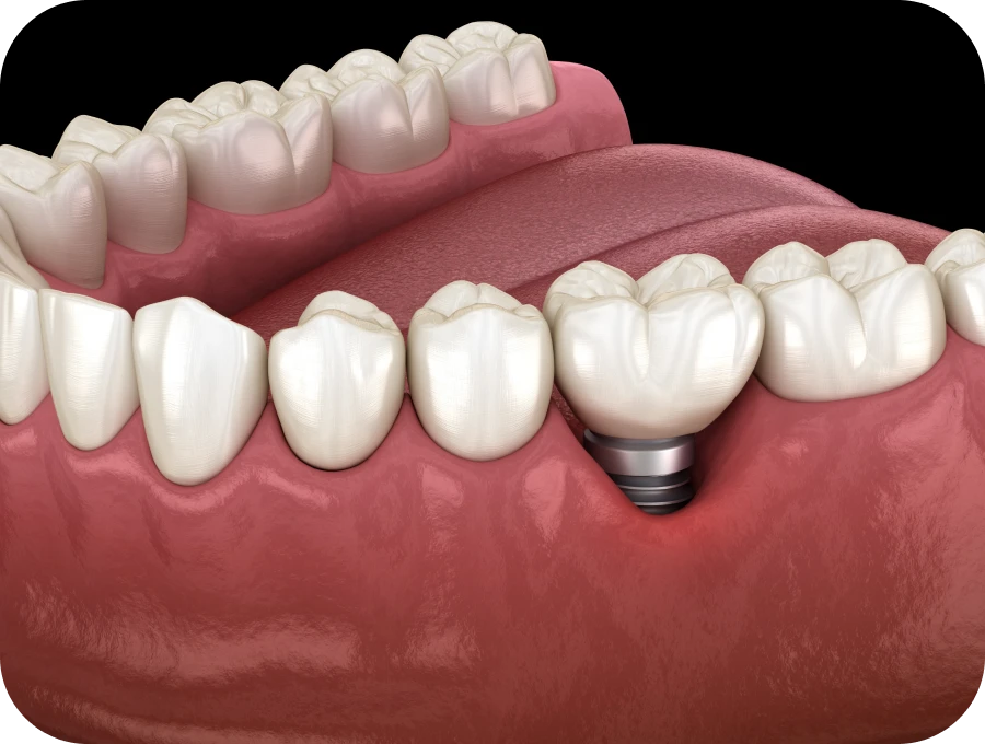 greffe peri-implantaire docteur sierocki