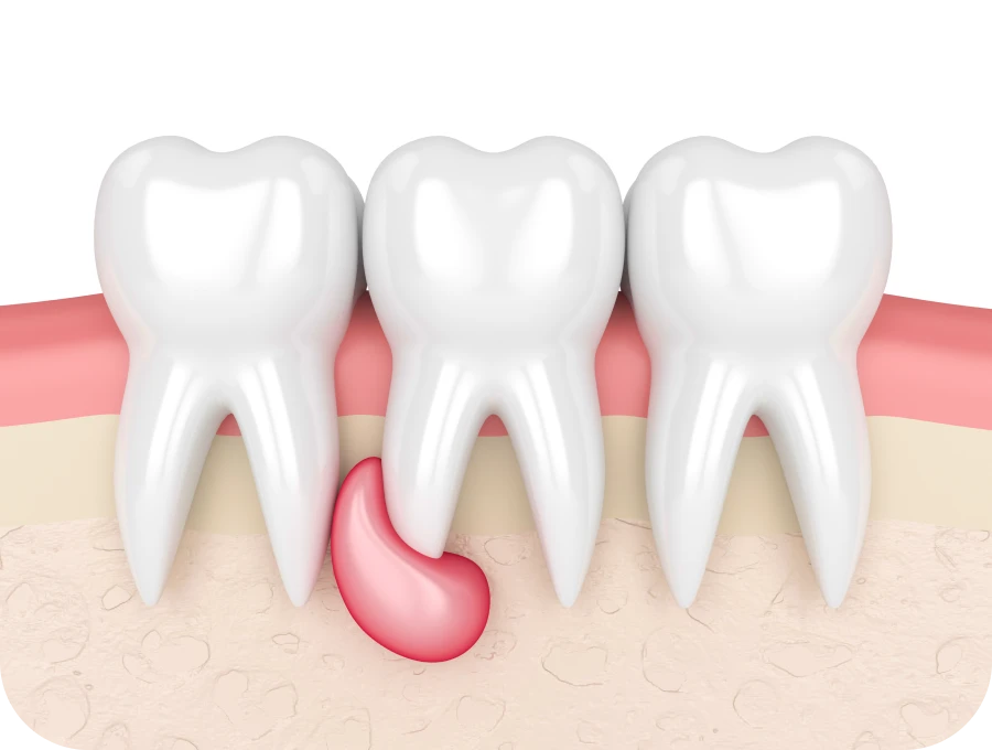 Traitement de kyste et d’abcès dentaire